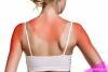 5 tips para aliviar las quemaduras de sol
