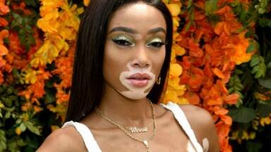Victoria's Secret comienza a romper estereotipos con una modelo con vitiligo 